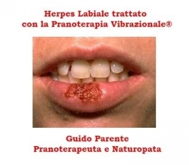 Herpes Labiale trattato con la Pranoterapia Vibrazionale® - StudioNaturopatiaGuidoParente