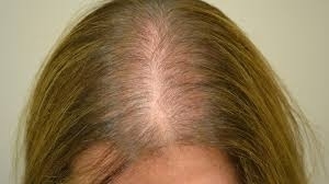 Alopecia,  con la Pranoterapia Vibrazionale e il trattamento Craniosacrale - StudioNaturopatiaGuidoParente