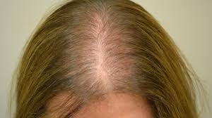 Alopecia,  con la Pranoterapia Vibrazionale e il trattamento Craniosacrale - StudioNaturopatia GuidoParente